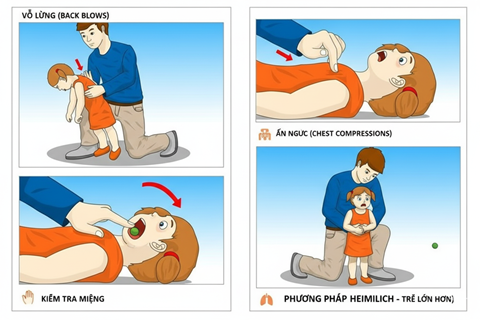 Kỹ Năng Sơ Cấp Cứu: Xử Lý Khi Trẻ Bị Hóc Dị Vật